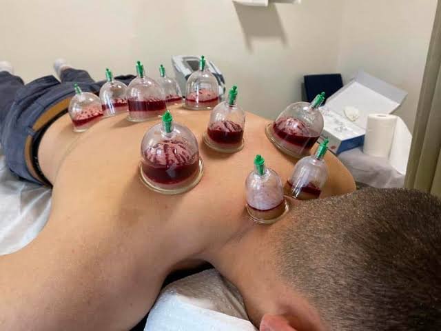 Cupping (Wet, Dry)