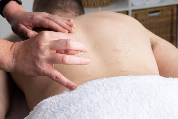 Dry Needling